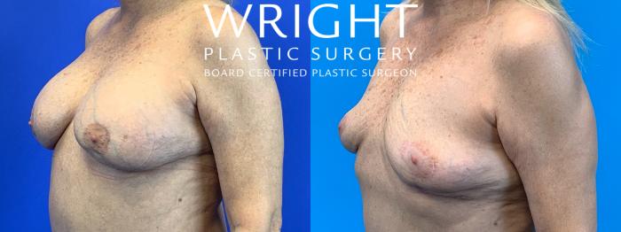 Before & After Breast Implant Removal Case 316 Left Oblique View in Little Rock, Arkansas