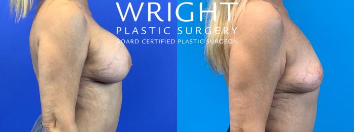 Before & After Breast Implant Removal Case 316 Right Side View in Little Rock, Arkansas