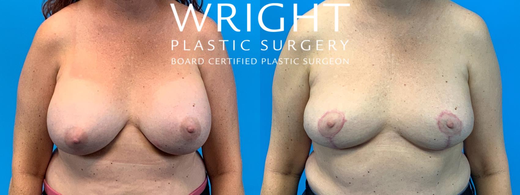 Before & After Breast Implant Removal Case 317 Front View in Little Rock, Arkansas