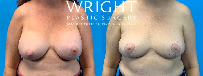 Before & After Breast Lift Case 317 Front View in Little Rock, Arkansas