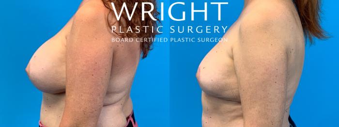 Before & After Breast Lift Case 317 Left Side View in Little Rock, Arkansas