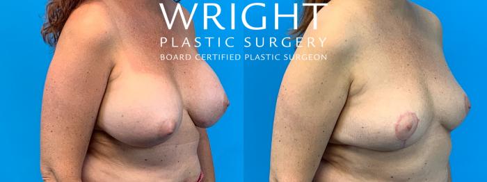 Before & After Breast Lift Case 317 Right Oblique View in Little Rock, Arkansas