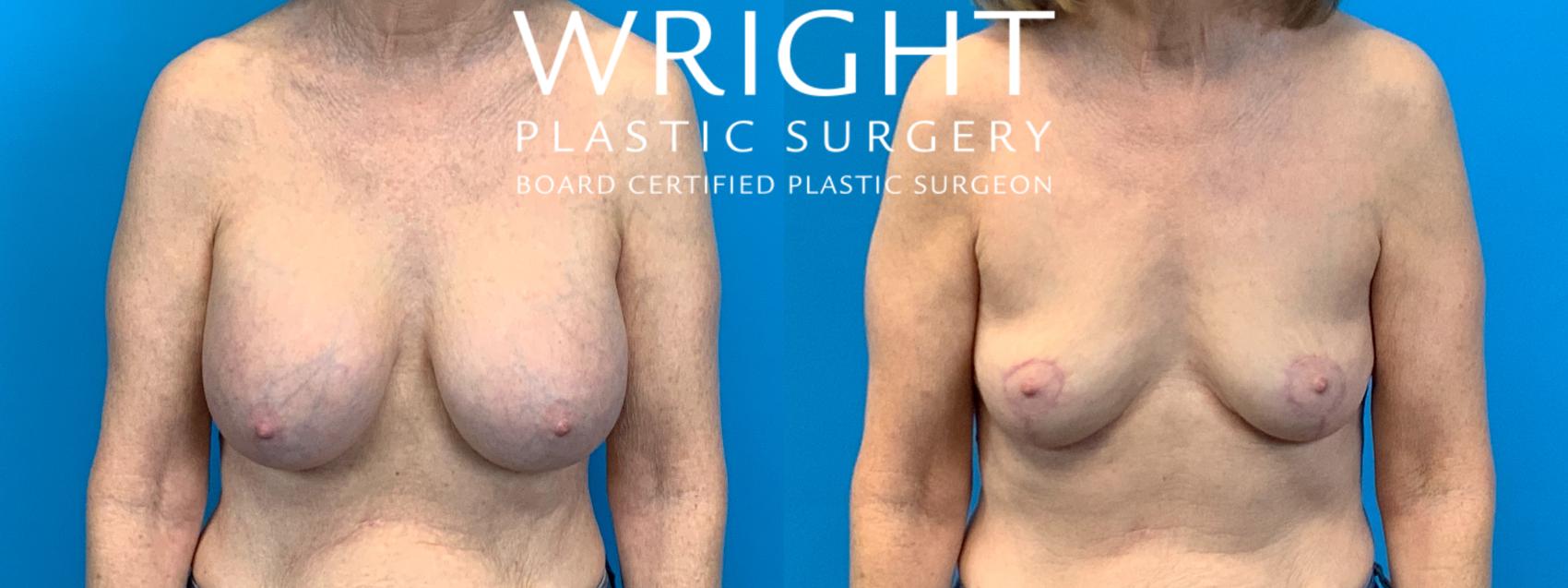 Before & After Breast Implant Removal Case 320 Front View in Little Rock, Arkansas