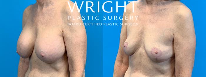 Before & After Breast Implant Removal Case 320 Left Oblique View in Little Rock, Arkansas