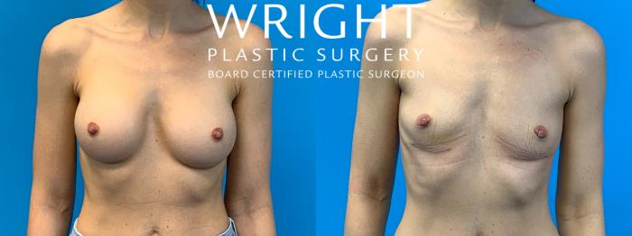 Before & After Breast Implant Removal Case 321 Front View in Little Rock, Arkansas