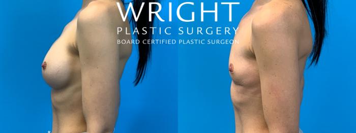 Before & After Breast Implant Removal Case 321 Left Side View in Little Rock, Arkansas