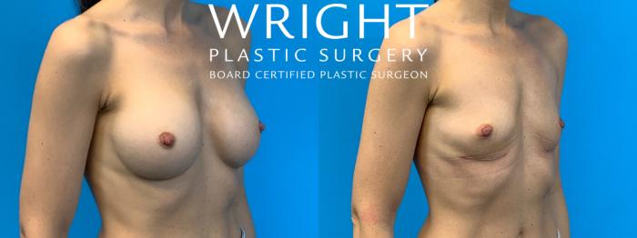 Before & After Breast Implant Removal Case 321 Right Oblique View in Little Rock, Arkansas