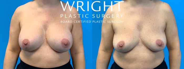 Before & After Breast Implant Removal Case 323 Front View in Little Rock, Arkansas