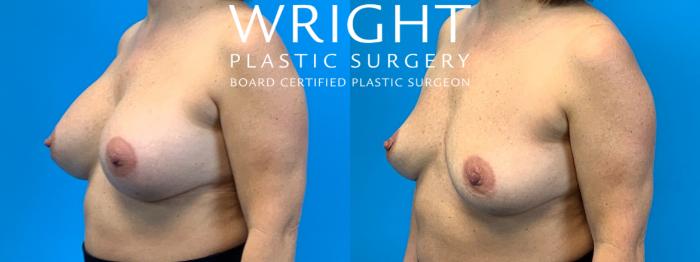 Before & After Breast Implant Removal Case 323 Left Oblique View in Little Rock, Arkansas