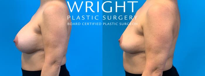 Before & After Breast Implant Removal Case 323 Left Side View in Little Rock, Arkansas
