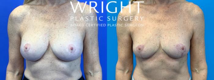 Before & After Breast Implant Removal Case 325 Front View in Little Rock, Arkansas