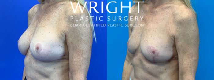 Before & After Breast Implant Removal Case 325 Left Oblique View in Little Rock, Arkansas