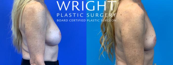 Before & After Breast Implant Removal Case 325 Right Side View in Little Rock, Arkansas