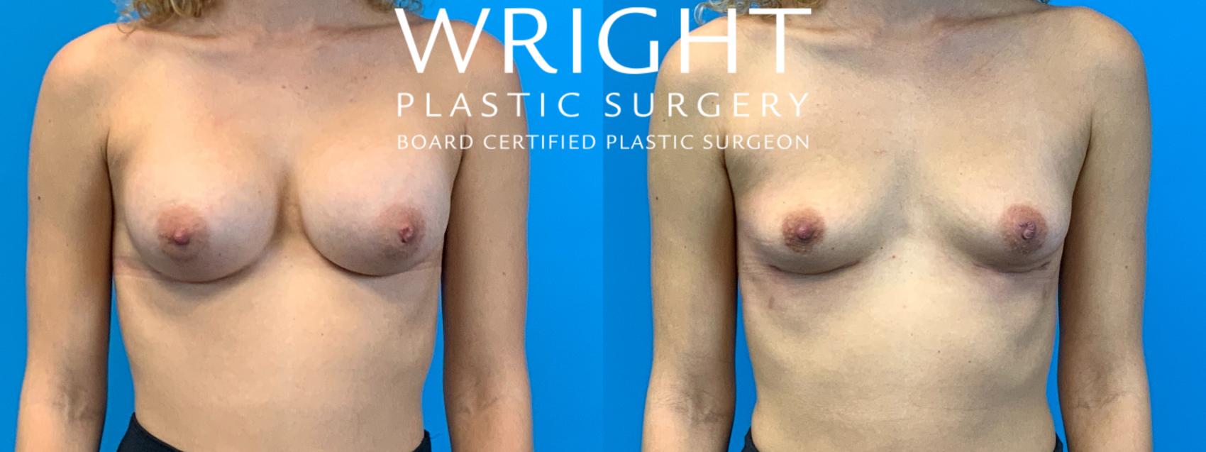 Before & After Breast Implant Removal Case 326 Front View in Little Rock, Arkansas