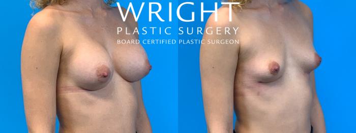Before & After Breast Implant Removal Case 326 Right Oblique View in Little Rock, Arkansas
