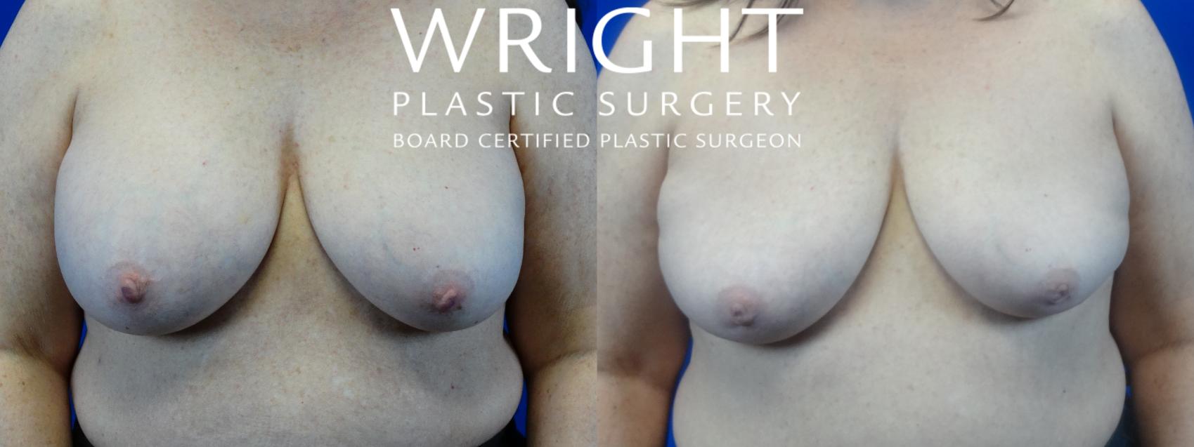 Before & After Breast Implant Removal Case 33 Front View in Little Rock, Arkansas