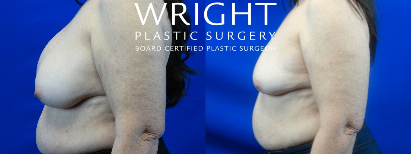 Before & After Breast Implant Removal Case 33 Left Side View in Little Rock, Arkansas