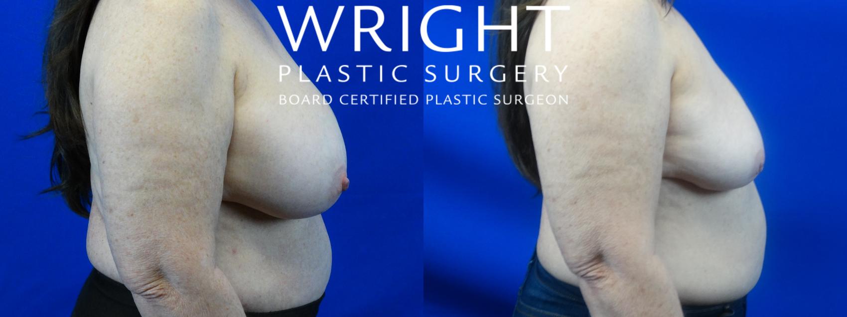 Before & After Breast Implant Removal Case 33 Right Side View in Little Rock, Arkansas