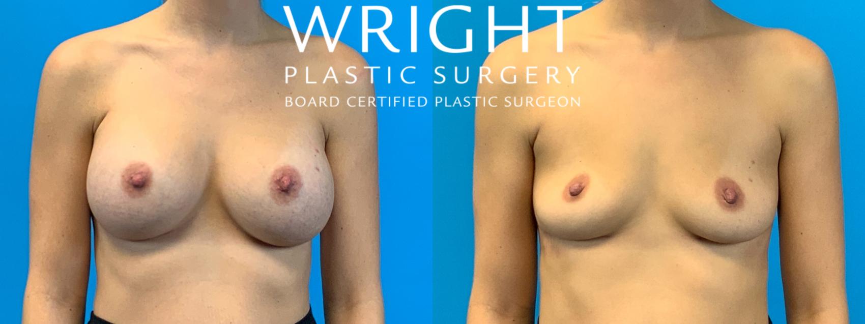 Before & After Breast Implant Removal Case 330 Front View in Little Rock, Arkansas