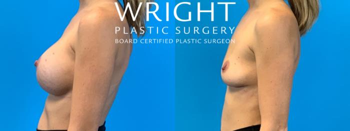 Before & After Breast Implant Removal Case 330 Left Side View in Little Rock, Arkansas