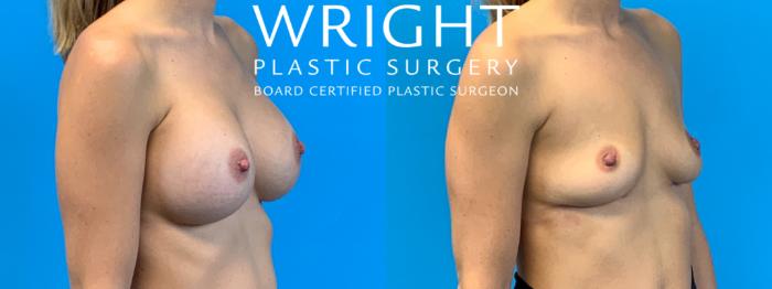 Before & After Breast Implant Removal Case 330 Right Oblique View in Little Rock, Arkansas