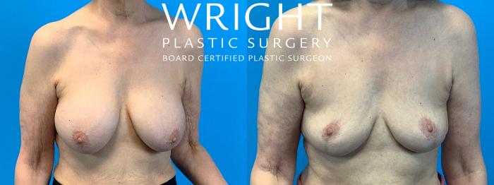 Before & After Breast Implant Removal Case 332 Front View in Little Rock, Arkansas