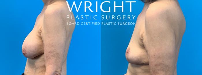 Before & After Breast Lift Case 332 Left Side View in Little Rock, Arkansas