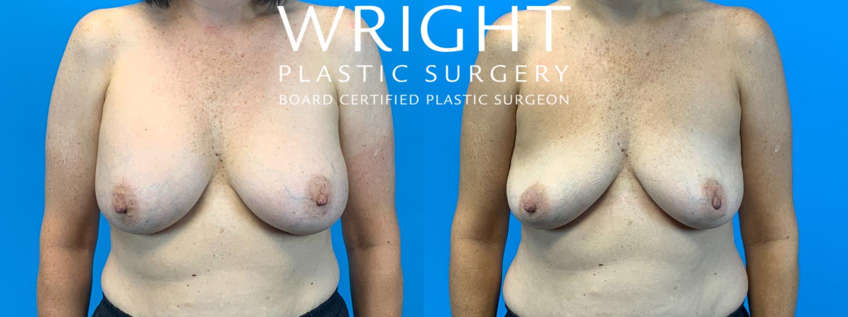 Before & After Breast Implant Removal Case 333 Front View in Little Rock, Arkansas