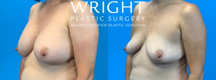 Before & After Breast Implant Removal Case 333 Left Oblique View in Little Rock, Arkansas