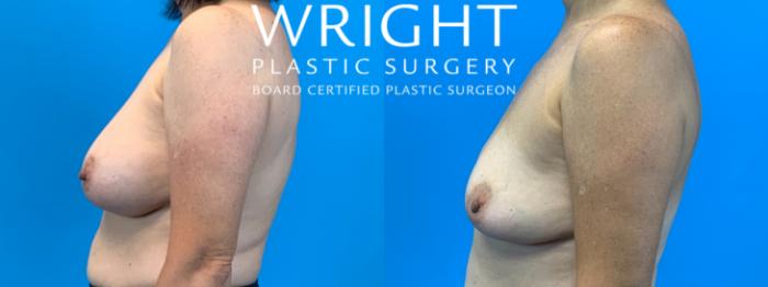 Before & After Breast Implant Removal Case 333 Left Side View in Little Rock, Arkansas