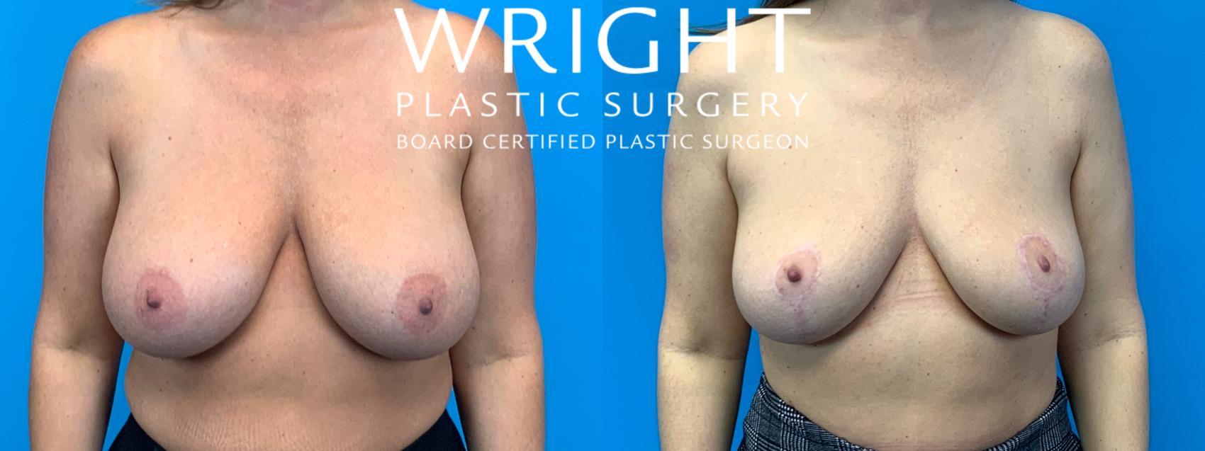 Before & After Breast Implant Removal Case 337 Front View in Little Rock, Arkansas