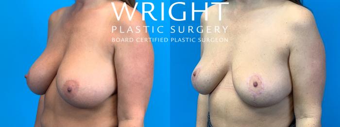Before & After Breast Implant Removal Case 337 Left Oblique View in Little Rock, Arkansas