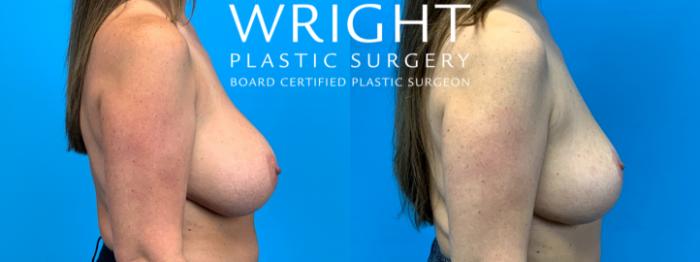 Before & After Breast Implant Removal Case 337 Right Side View in Little Rock, Arkansas