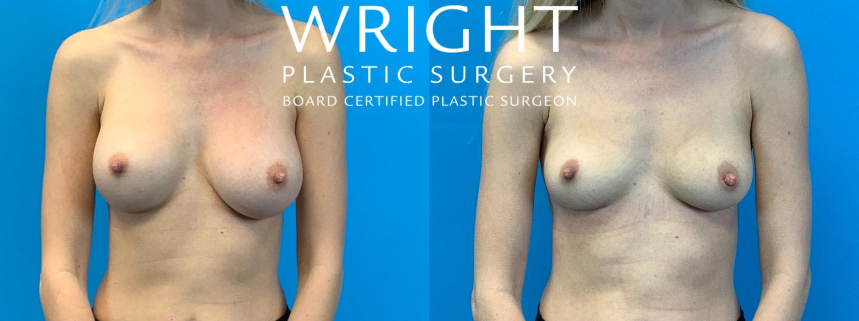 Before & After Breast Implant Removal Case 339 Front View in Little Rock, Arkansas
