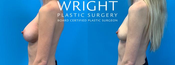 Before & After Breast Implant Removal Case 339 Left Side View in Little Rock, Arkansas