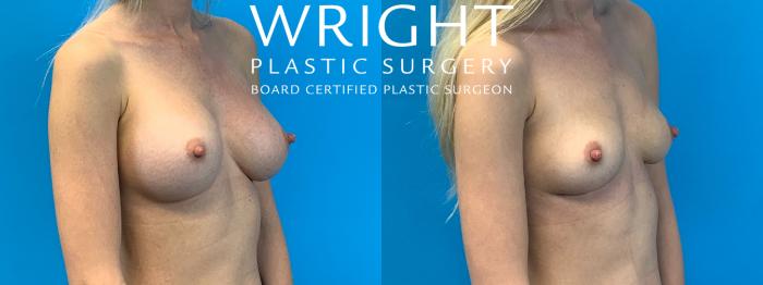 Before & After Breast Implant Removal Case 339 Right Oblique View in Little Rock, Arkansas