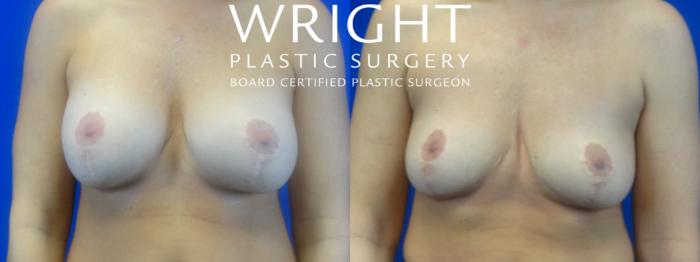 Before & After Breast Implant Removal Case 34 Front View in Little Rock, Arkansas
