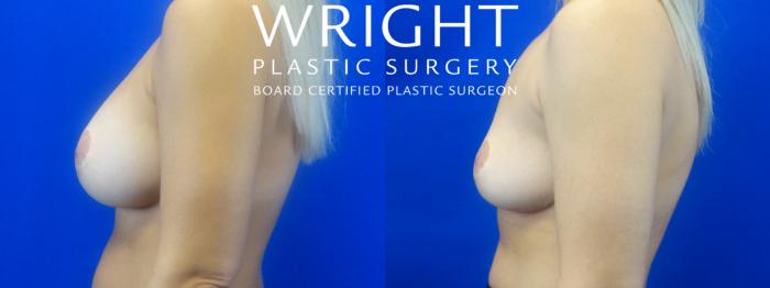 Before & After Breast Implant Removal Case 34 Left Side View in Little Rock, Arkansas