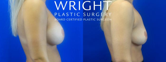 Before & After Breast Implant Removal Case 34 Right Side View in Little Rock, Arkansas