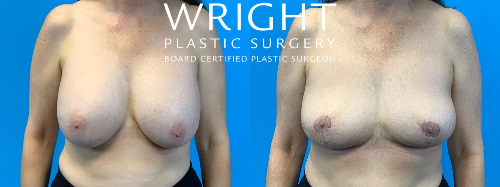 Before & After Breast Implant Removal Case 346 Front View in Little Rock, Arkansas