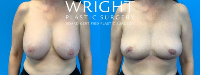 Before & After Breast Lift Case 346 Front View in Little Rock, Arkansas