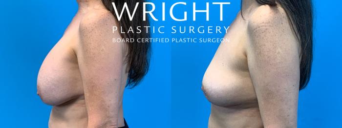 Before & After Breast Lift Case 346 Left Side View in Little Rock, Arkansas