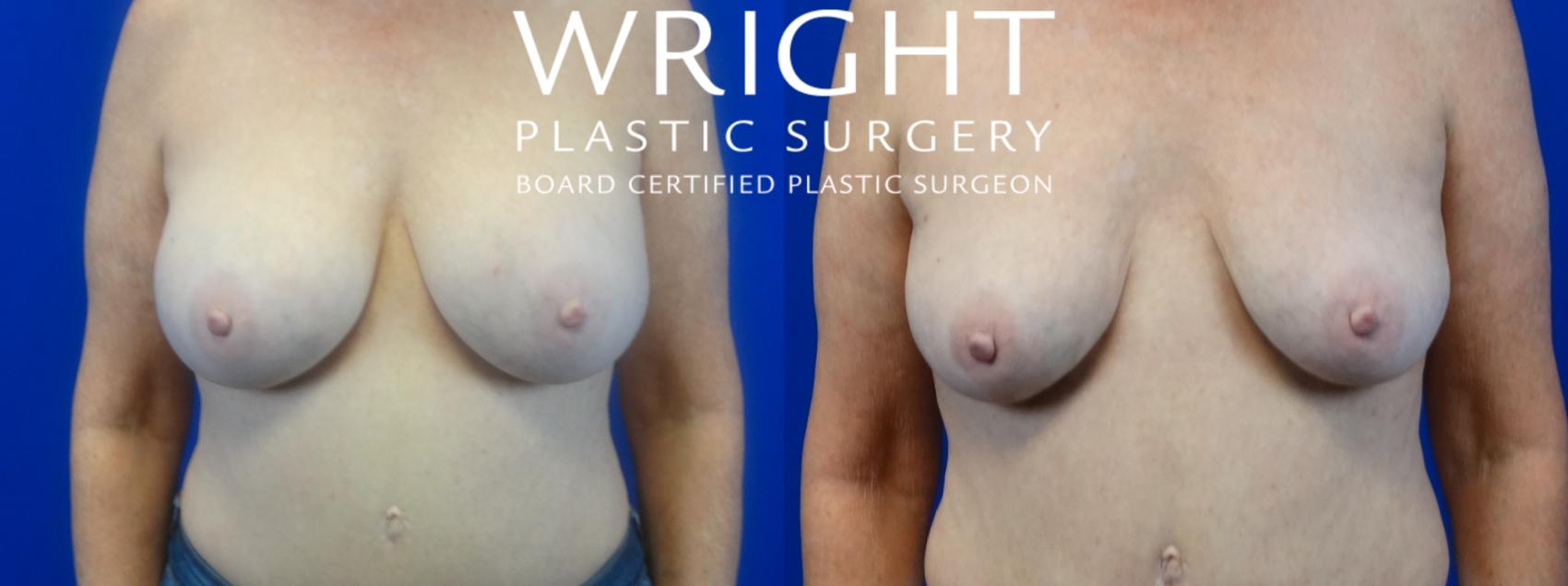 Before & After Breast Implant Removal Case 35 Front View in Little Rock, Arkansas