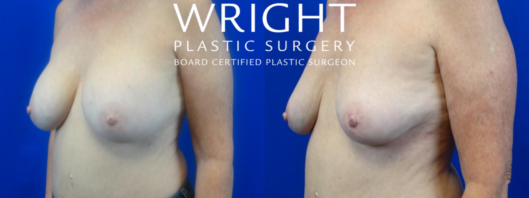 Before & After Breast Implant Removal Case 35 Left Oblique View in Little Rock, Arkansas
