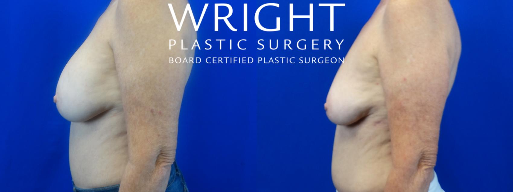 Before & After Breast Implant Removal Case 35 Left Side View in Little Rock, Arkansas