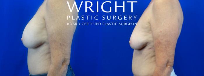 Before & After Breast Implant Removal Case 35 Left Side View in Little Rock, Arkansas