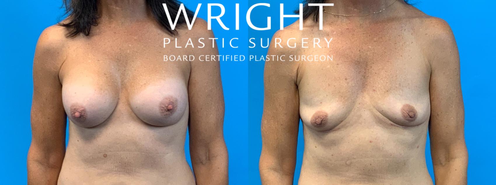 Before & After Breast Implant Removal Case 354 Front View in Little Rock, Arkansas