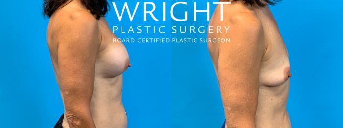 Before & After Breast Implant Removal Case 354 Right Side View in Little Rock, Arkansas
