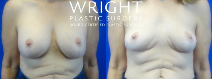 Before & After Breast Implant Removal Case 36 Front View in Little Rock, Arkansas