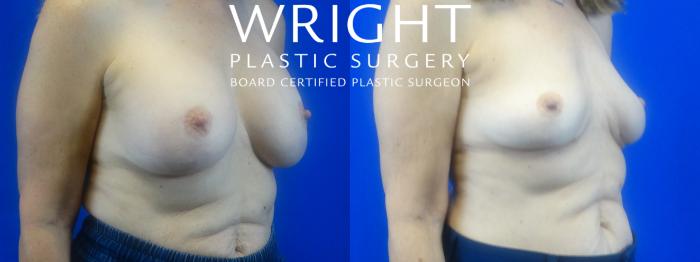 Before & After Breast Implant Removal Case 36 Right Oblique View in Little Rock, Arkansas